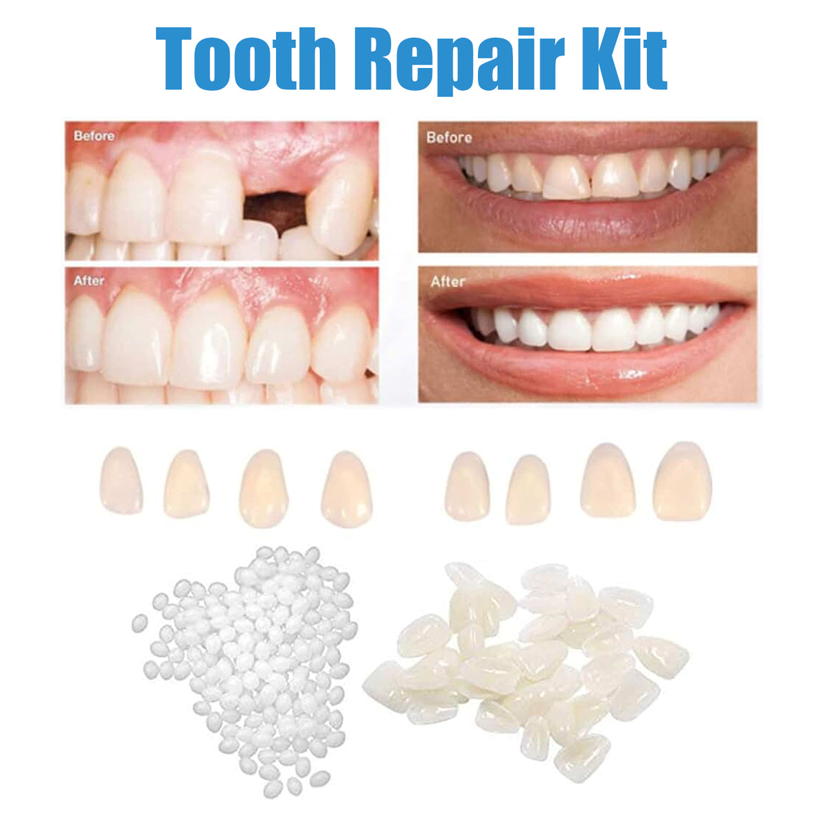 Alvantor Temporary Tooth Replacement Kit, Repair Beads for Fixing Filling Missing Broken Tooth, 1.05oz